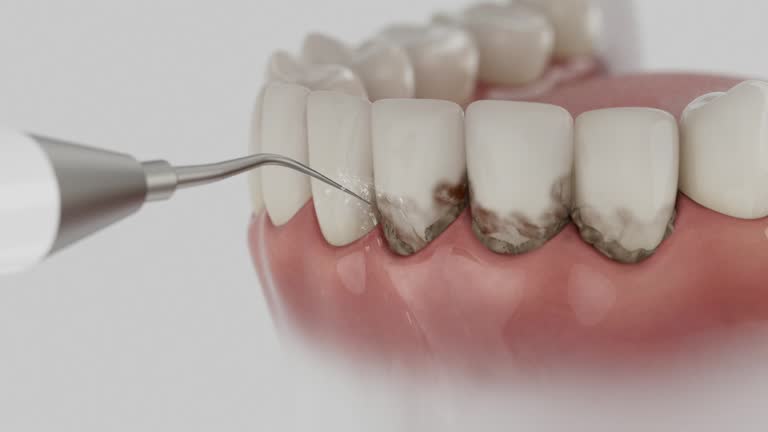 Trusted Wisdom Tooth Removal service in Greensburg, KY - Dentist Open Now
